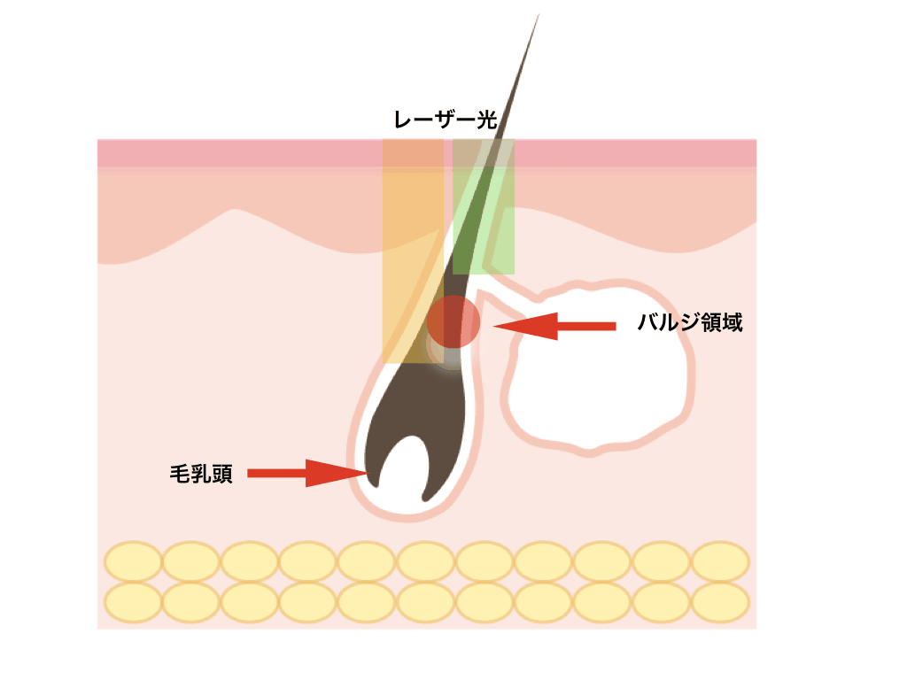 蓄熱式（SHR式）のレーザー脱毛器の脱毛効果には疑問符も？
